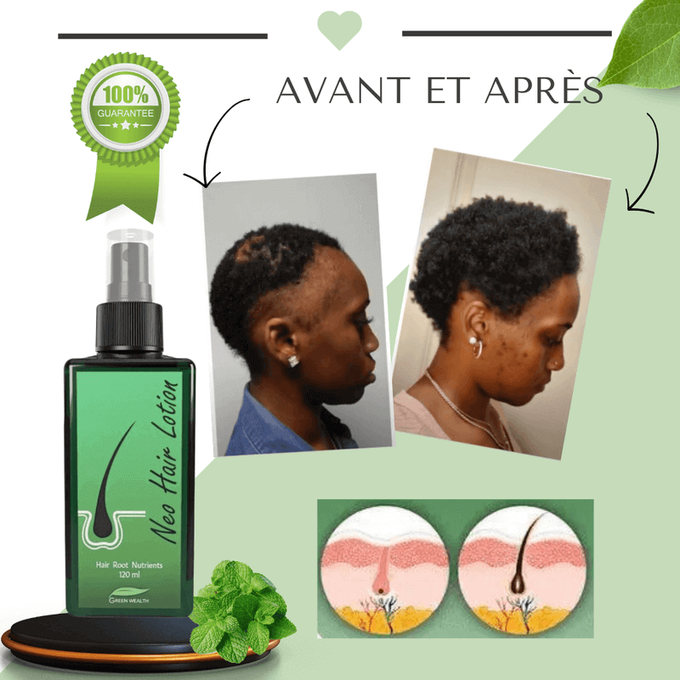 Dites adieu aux cheveux clairsemés et aux plaques chauves avec Neo Hair!