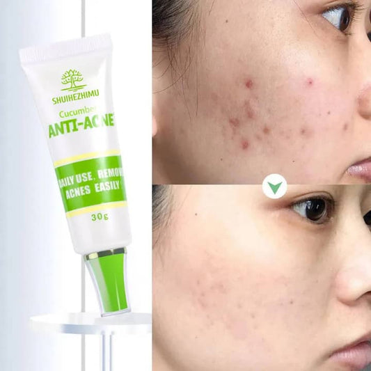Crème Anti-Acné Naturelle à l’Aloe Vera