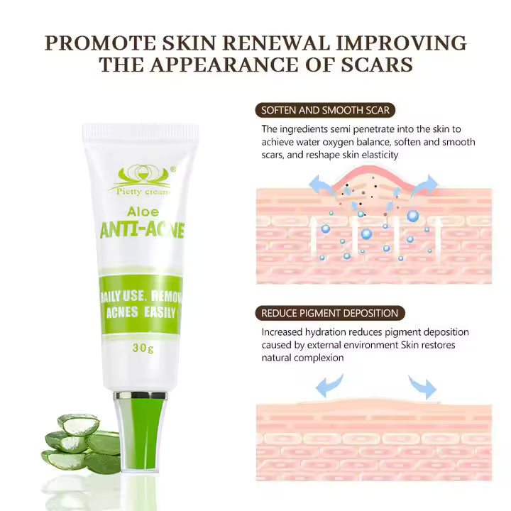 Crème Anti-Acné Naturelle à l’Aloe Vera